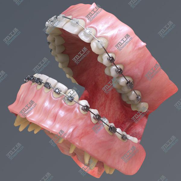 images/goods_img/20210312/Permanent Dentition with Braces/3.jpg
